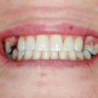 Dental Bridges - Smile 28 before